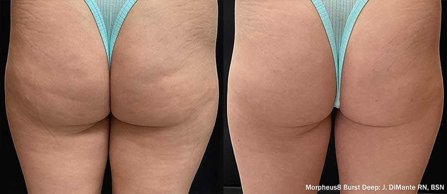 Morpheus8-Before-and-After-Buttocks-Banana-Rolls