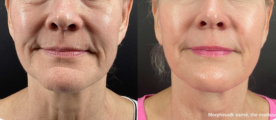 Morpheus8 Before and After - Wrinkles Smile Lines Nasolabial Folds