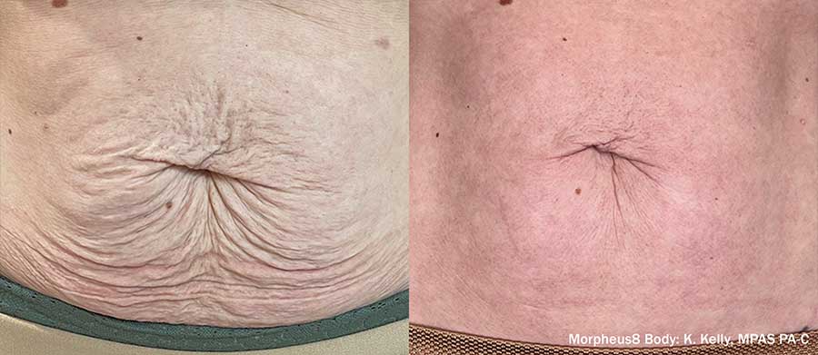 Morpheus8-Body-Before-and-After-Abdomen-Tummy-Tuck