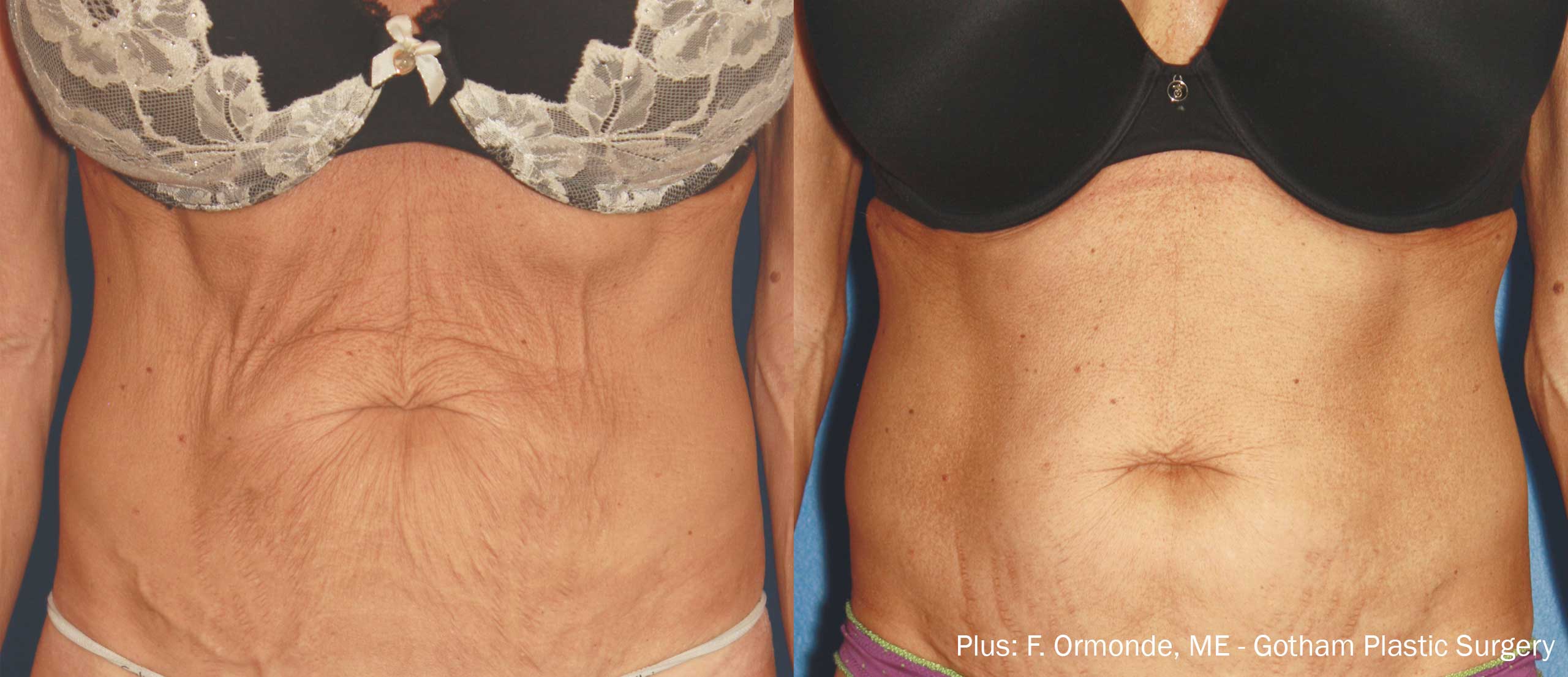 Plus Before and After Tummy Tightening