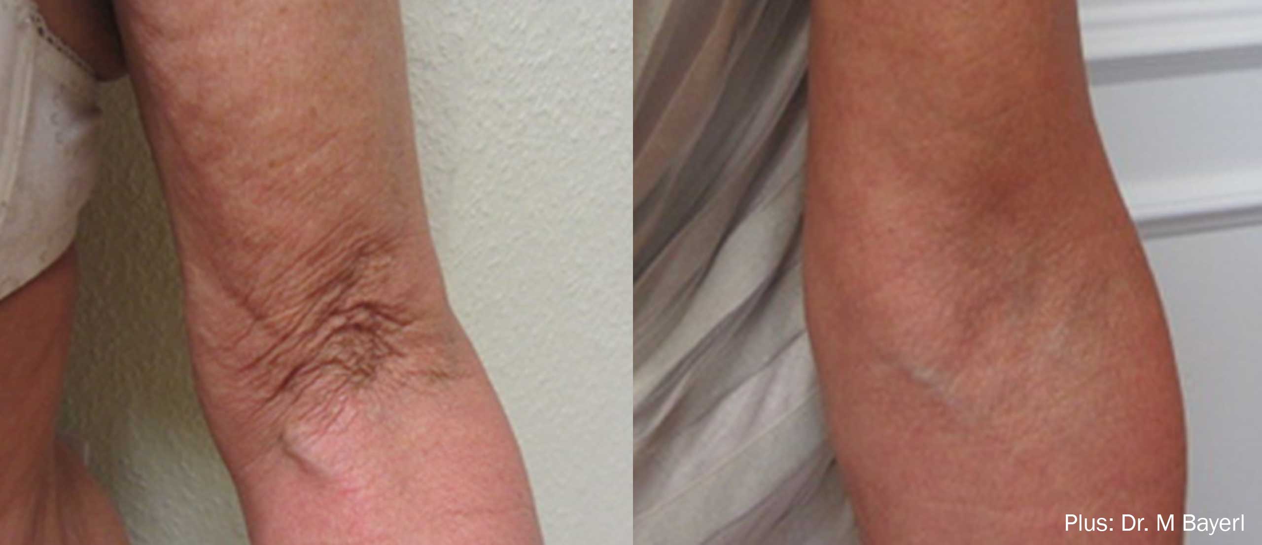 Plus Before and After Wrinkled Skin
