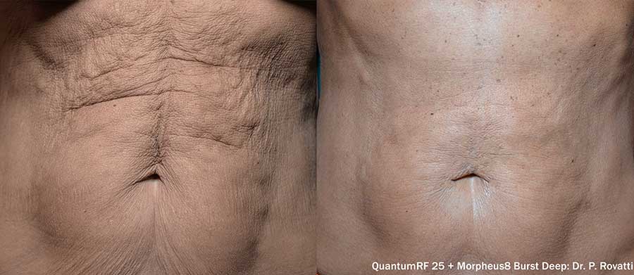 QuantumRF-Before-and-After-Abdomen
