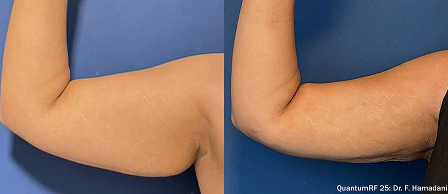 QuantumRF-Before-and-After-Bat-Arms