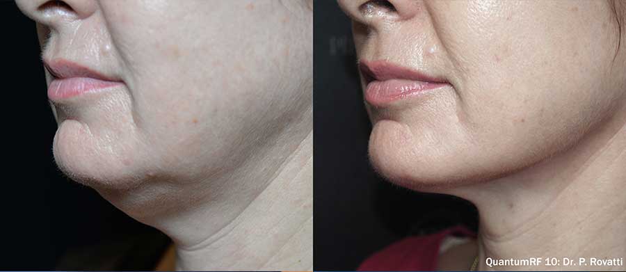 QuantumRF-Before-and-After-Jowls