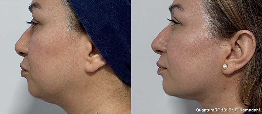 QuantumRF-Before-and-After-Necklift-Submental