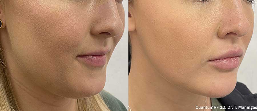 QuantumRF-Before-and-After-Snatched-Jawline