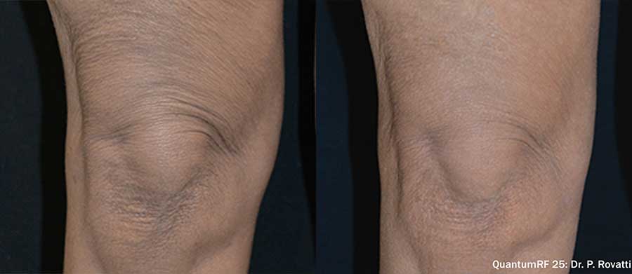 QuantumRF-Before-and-After-Wrinkled-Knees