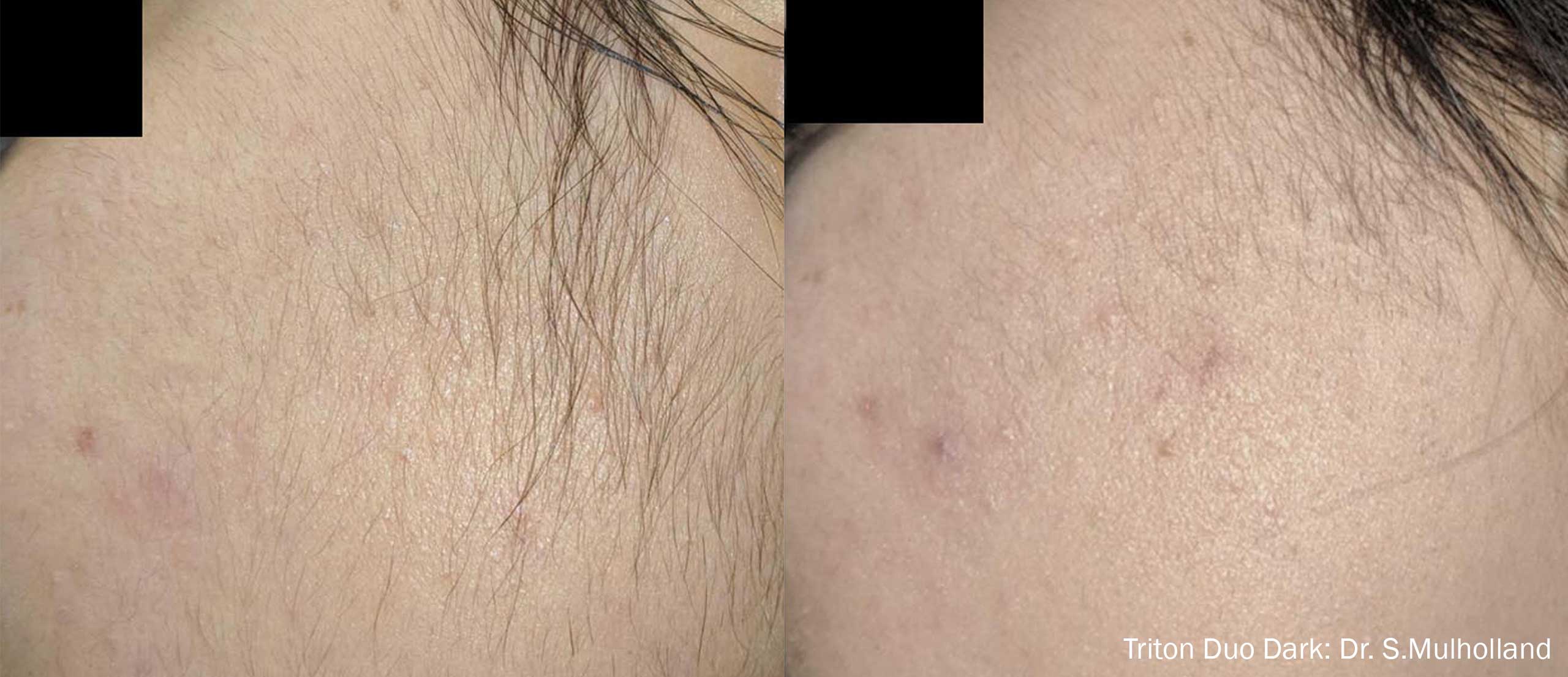 Triton Before and After Sideburns Baby Hairs