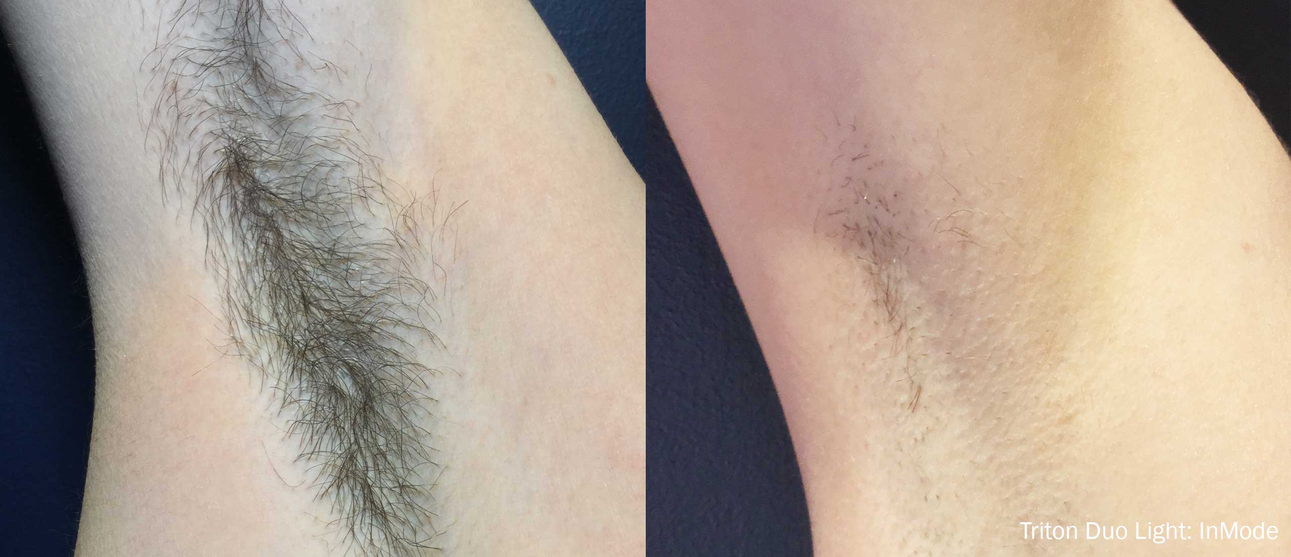 Triton Before and After Underarm