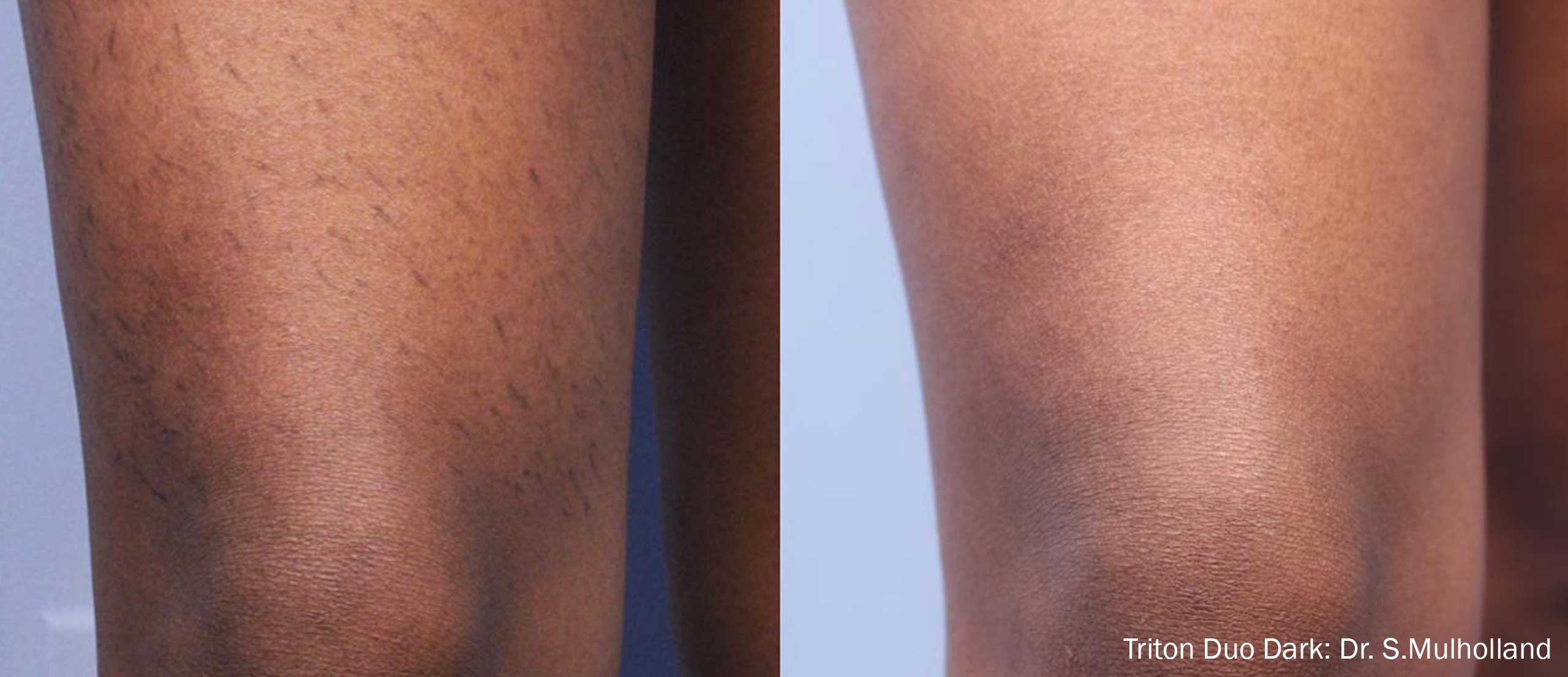 Triton Duo Dark Before and After