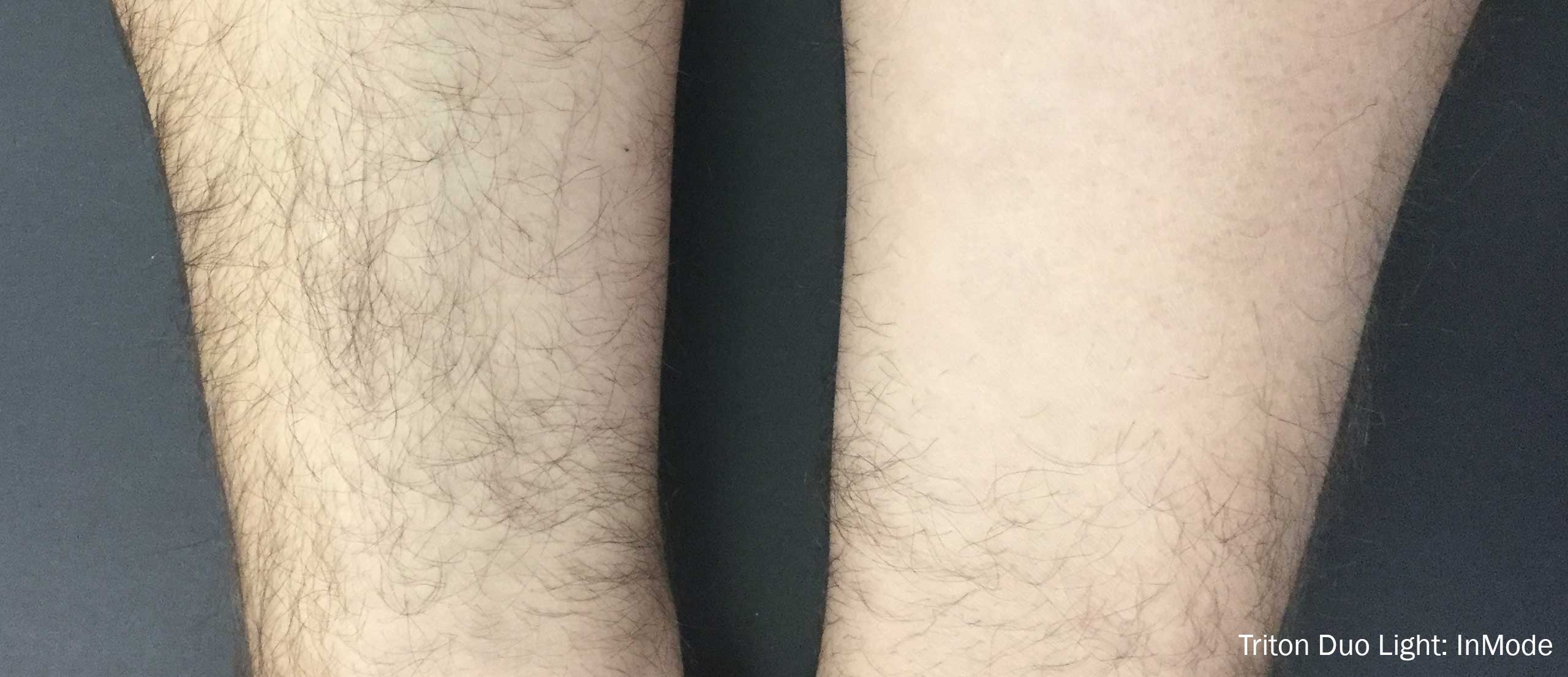 Triton Duo Light Before and After