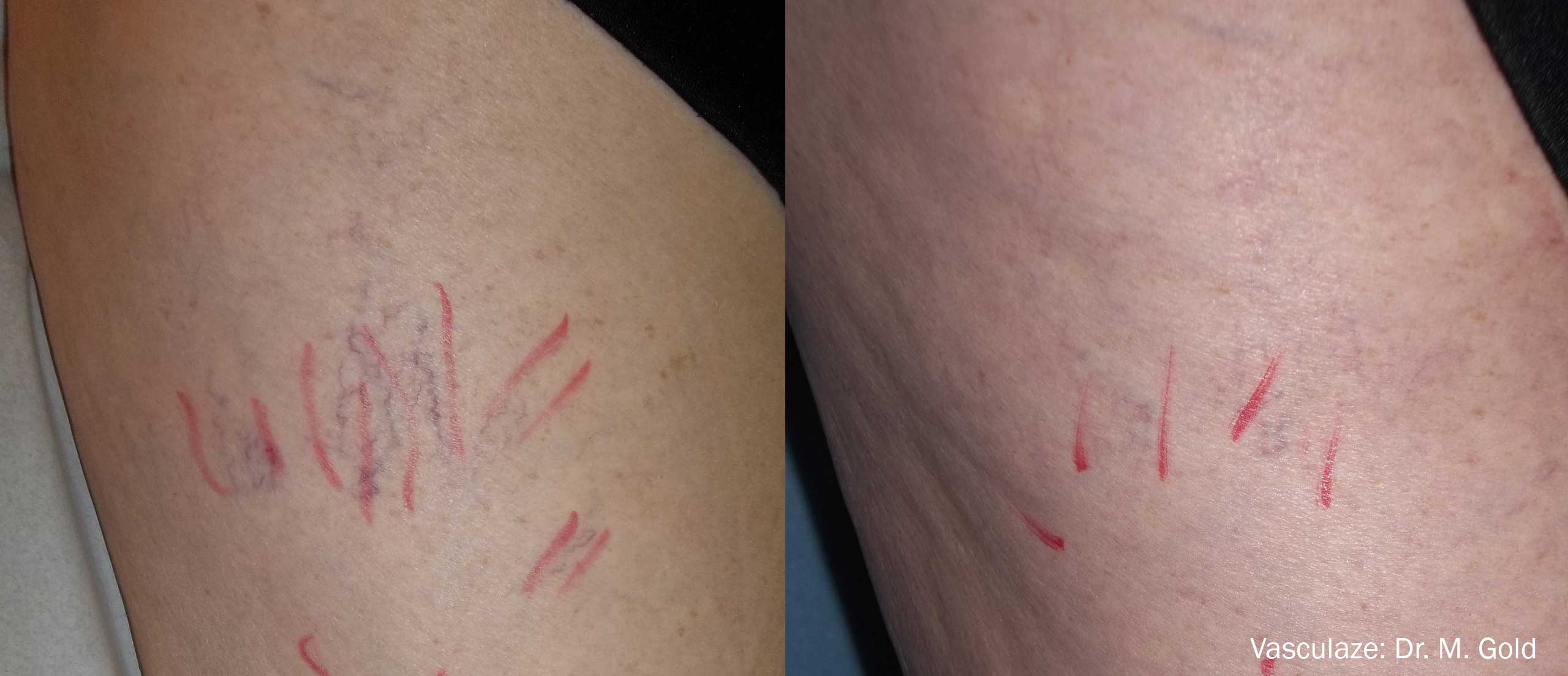 Vasculaze Before and After