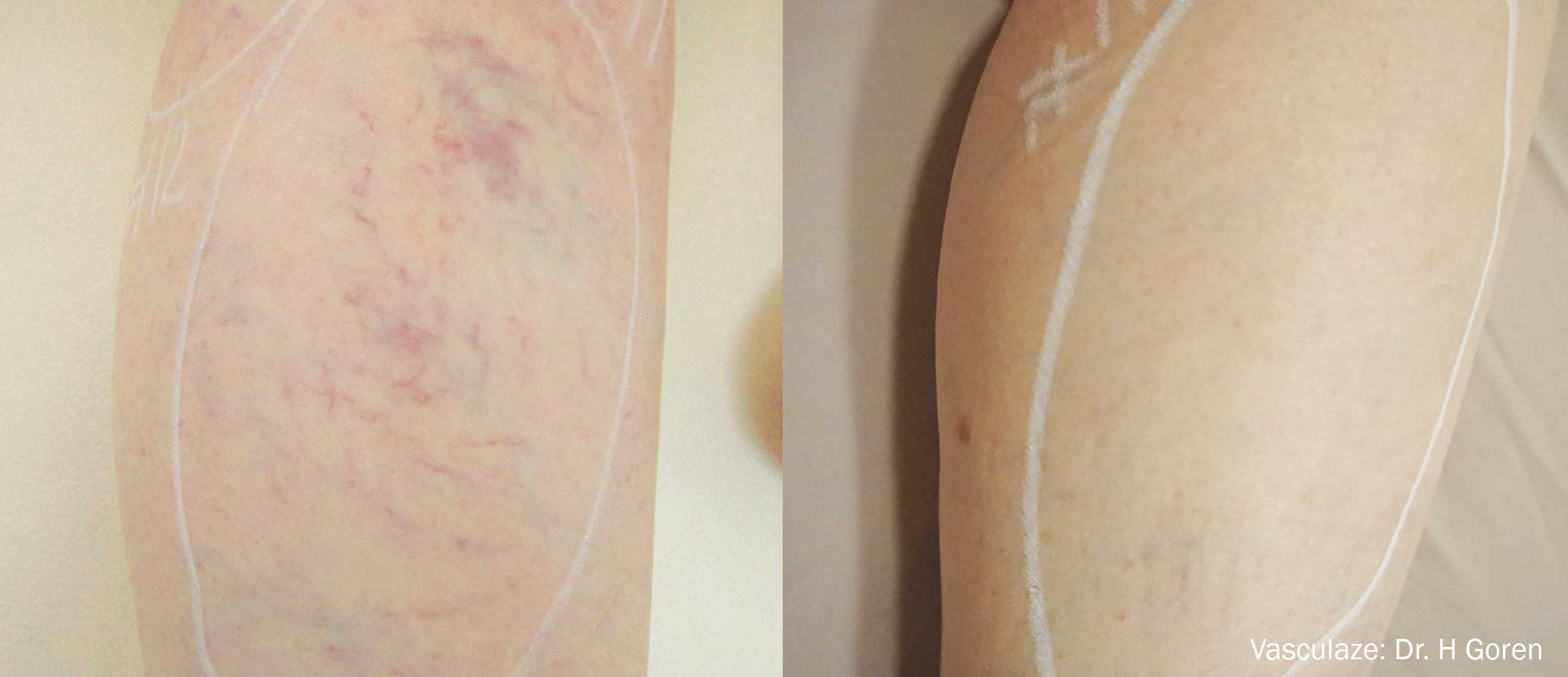 Vasculaze Before and After