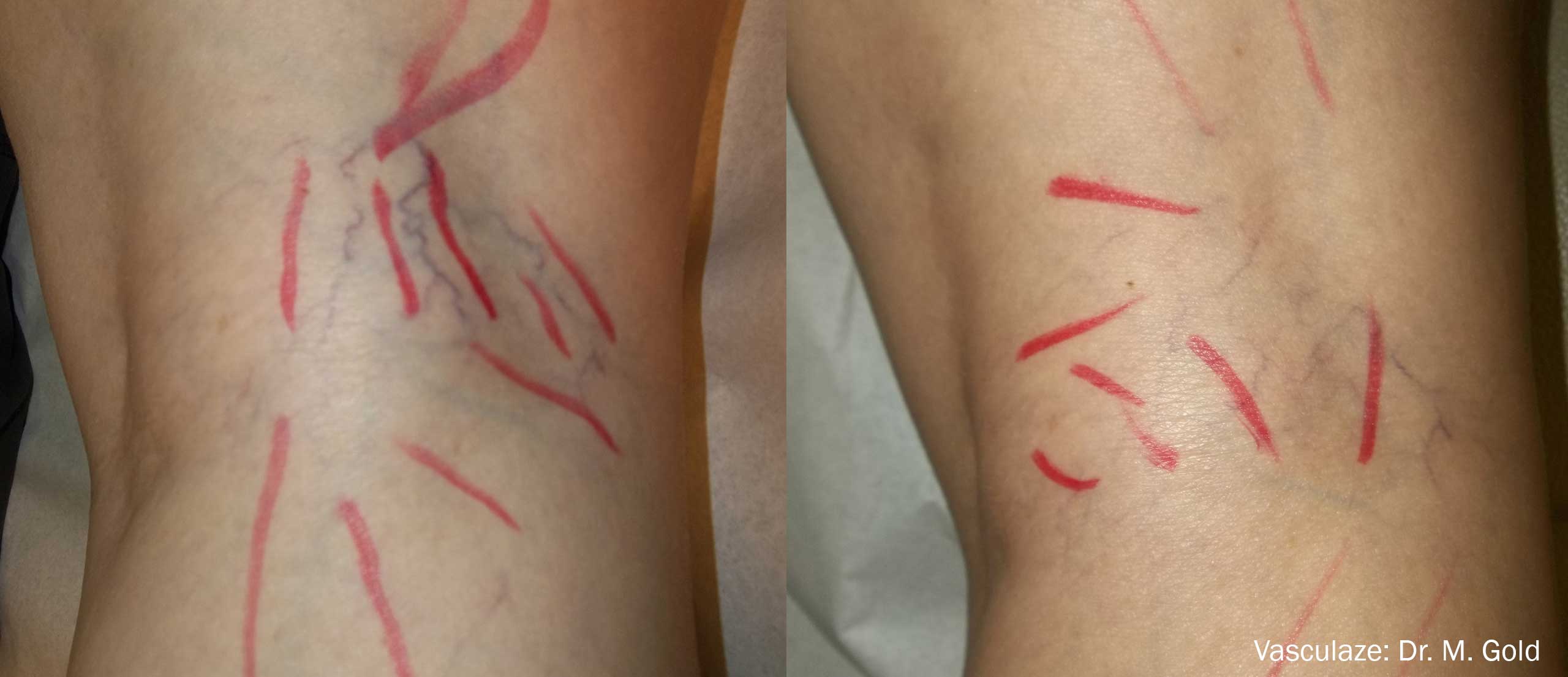 Vasculaze Before and After