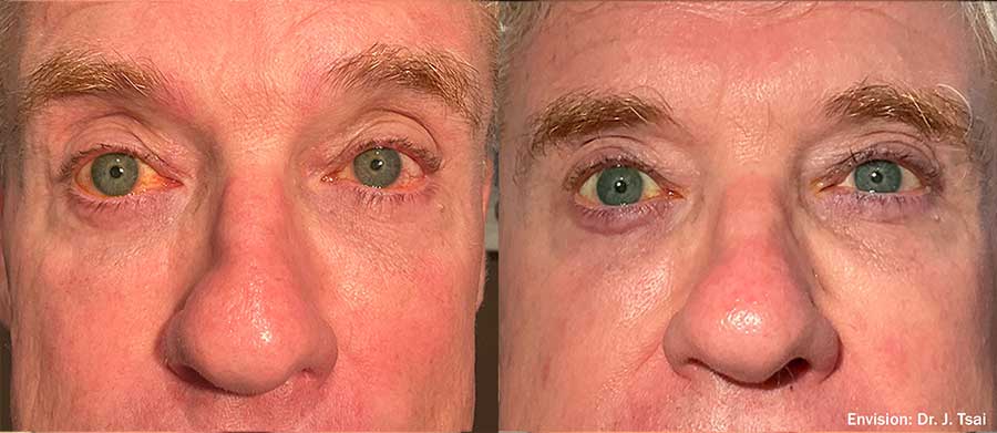 Envision-FormaI-Before-and-After-Dry-Eye-1