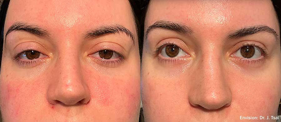 Envision-FormaI-Before-and-After-Dry-Eye-2