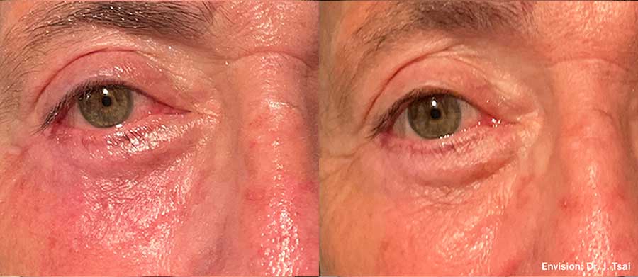 Envision-FormaI-Before-and-After-Dry-Eye-3