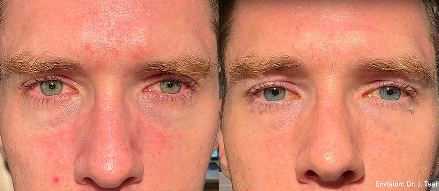 Envision-FormaI-Before-and-After-Dry-Eye-4