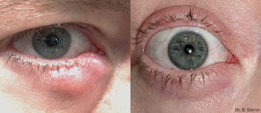 Envision-FormaI-Before-and-After-Dry-Eye